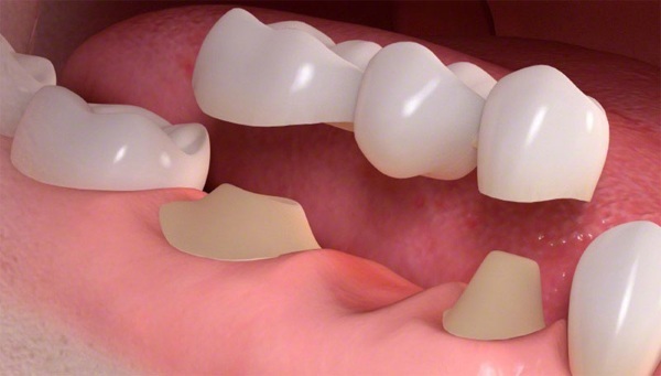 Dental treatment, dentures, cleaning, removal of free MHI policy. Where possible, which includes