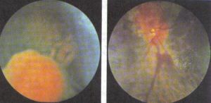 pathologie oculaire