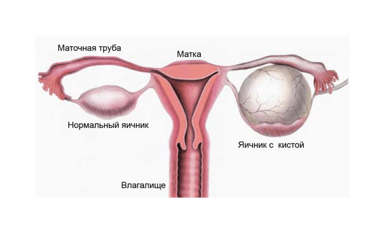 Kista ovarium