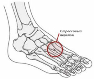 stressfractuur van de voet