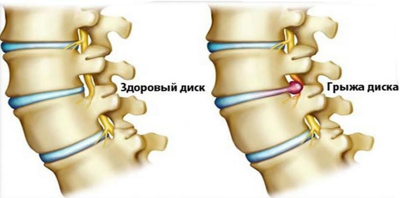 Intervertebral hernia can occur due to high physical exertion