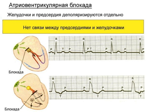 AV block 1-2-3 degrees on ECG Mobitz. What is it, the reasons, the treatment