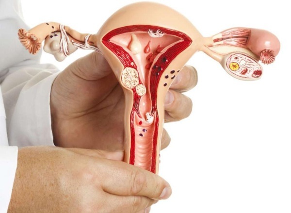 Disfungsi ovarium. Apa itu pada wanita, remaja, gejala, pengobatan, penyebab
