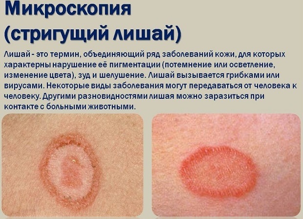Mikrosporija pri otrocih (versicolor). Fotografija, zdravljenje gladke kože, lasišča, simptomi, inkubacijska doba, karantena