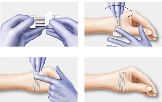 A tightening plaster for wounds, stitches, cuts. How to apply, where to buy, price, reviews