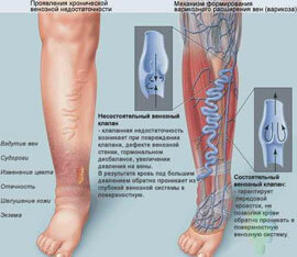 About varicose veins