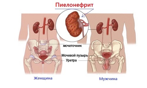 Pyelonephritis in men