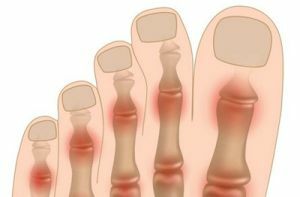 Polyarthrose af fødderne