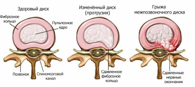 Stepwise development of the intervertebral hernia