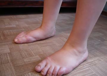 Flat-footedness will change posture