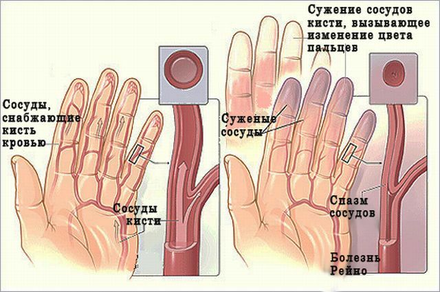 Makšties patologija Raynaud liga - priežastys, simptomai ir gydymas