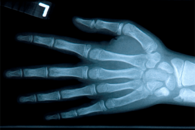 Radiographie de la main