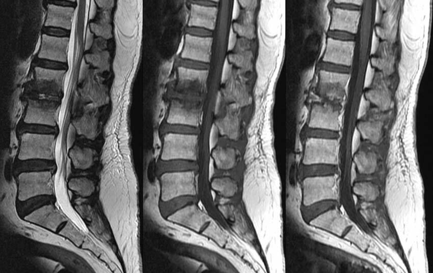 deformación de la columna vertebral