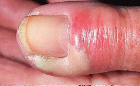 Panaritium finger på håndfoto