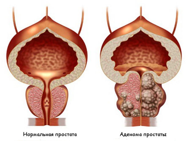TRUZY. Förberedelse för studier av prostatakörteln, urinblåsa, tolkning av resultaten