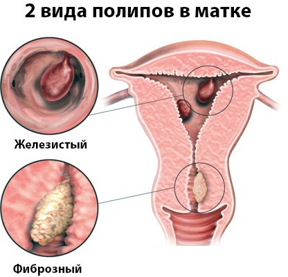 Fibro-glandulær endometriepolyp. Hvad er det, behandlingen efter fjernelse af