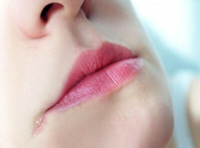 Zaeda v koutcích úst( rtů): příčiny, léčba, masti, léky