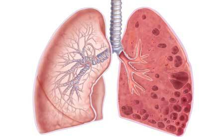 Emphysema af lungerne, hvad er det? - Symptomer, behandling, livsforudsigelse