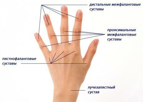 Risartrite - arthrite de la première articulation métacarpienne