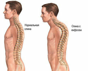 Kyphose af thoracal rygsøjlen
