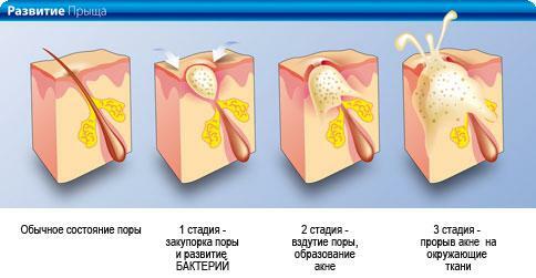 Stages of development of acne
