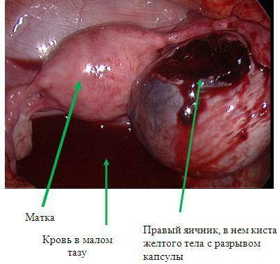 Hemorrhage in the ovary due to cysts