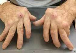 Komplikationer af rheumatoid arthritis