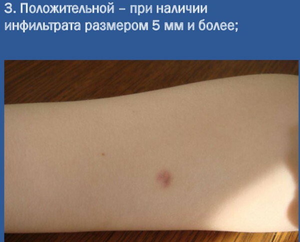 Er normen et blå mærke på stedet for Diaskintest efter vaccination? Foto