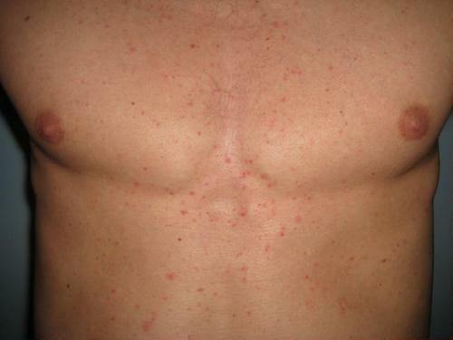 Allergie cutanee: macchie rosse sono prurito, trattamento