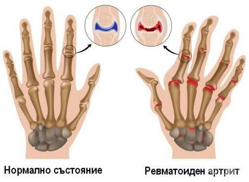 Scheme of rheumatoid arthritis