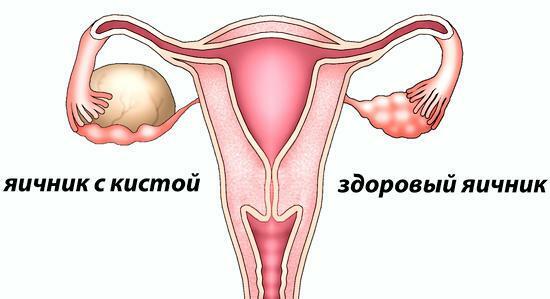 Symptomer på ovariecyster, symptomer
