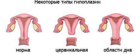Hypoplasia av livmoren i grader