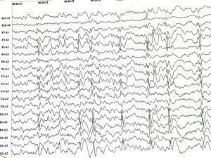 Diagnosis of benign myoclonic epilepsy
