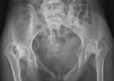Radiographie für Diagnostik und Osteoporose