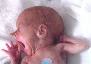 dítě s meningitidou