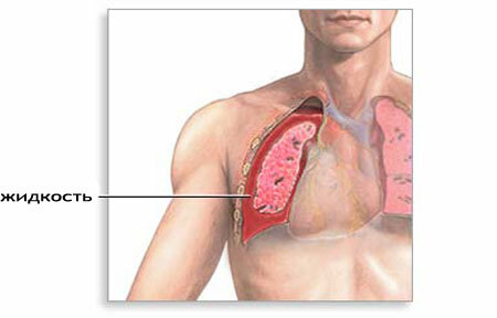 Hydrothorax - hvad er det?Årsager, tegn og behandling