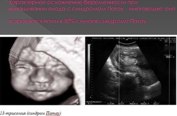 Trisomie 13 (Patau-Syndrom). Normale Indikatoren, was bedeutet das bei Schwangeren, Fötus, Risiko, Ursachen