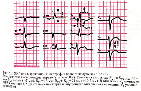 Right ventricular hypertrophy on the ECG. Signs, treatment