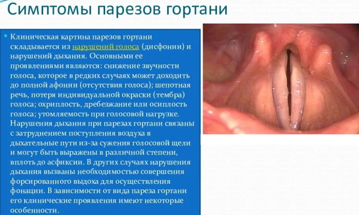 Paresis of the vocal cords. What is it, treatment, gymnastics