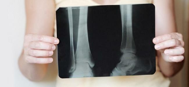 Osteoporose af knogler på røntgen