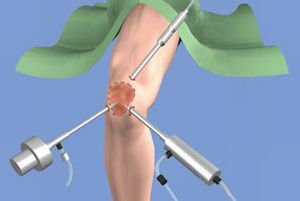 synovectomie van het kniegewricht
