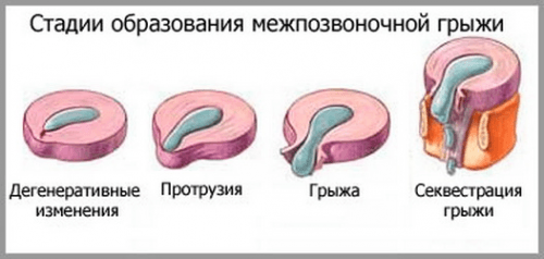 Stages of formation of the intervertebral hernia