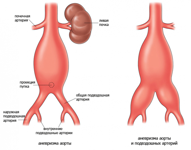 Aneurysm of the abdominal aorta