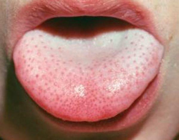 Hautausschläge in der Zunge
