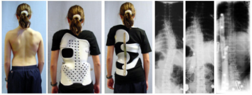 Features of the design of the corset Chenot, and the basis of the mechanism of action of the corrective devices in scoliosis