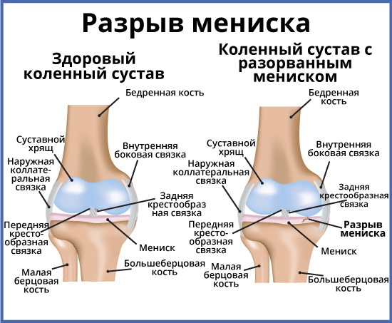 Rupture du ménisque du genou. Symptômes et traitement