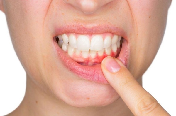 Inflamed gums. What to do, than to rinse as a treat at home