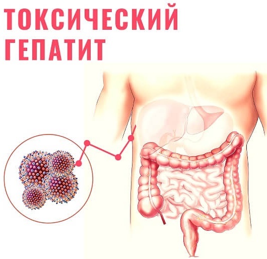 Toxic hepatitis. What is it, symptoms, treatment, clinical guidelines