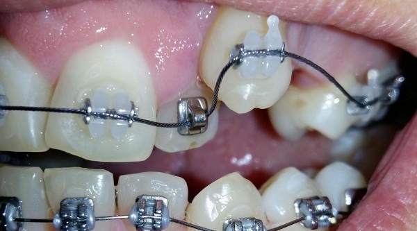 Tandlæge-ortodontist. Hvad gør et barn, en voksen