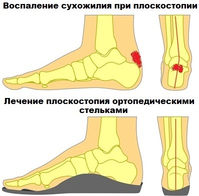 Achilles tendon inflammation. Causes and treatment, ointments